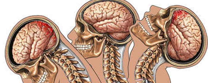 Traumatic Brain Injury Compensation